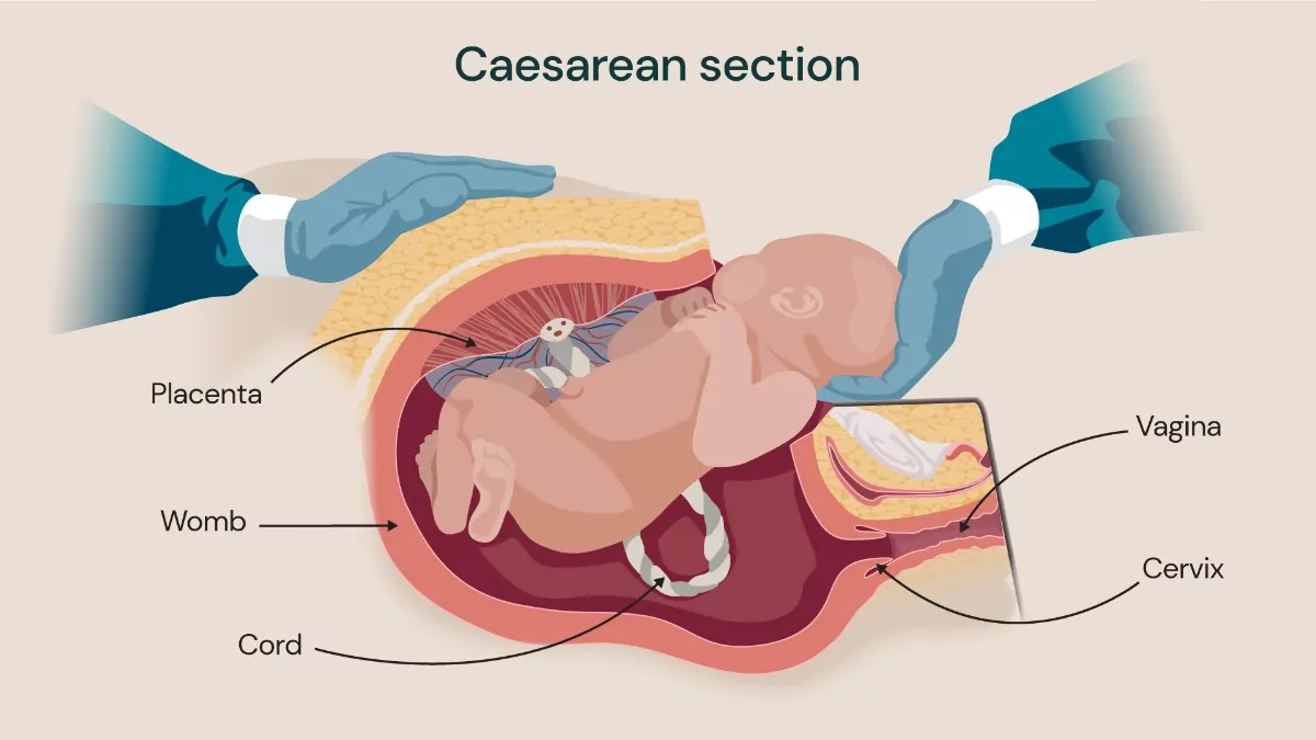Caesarean Delivery Doctor in Noida