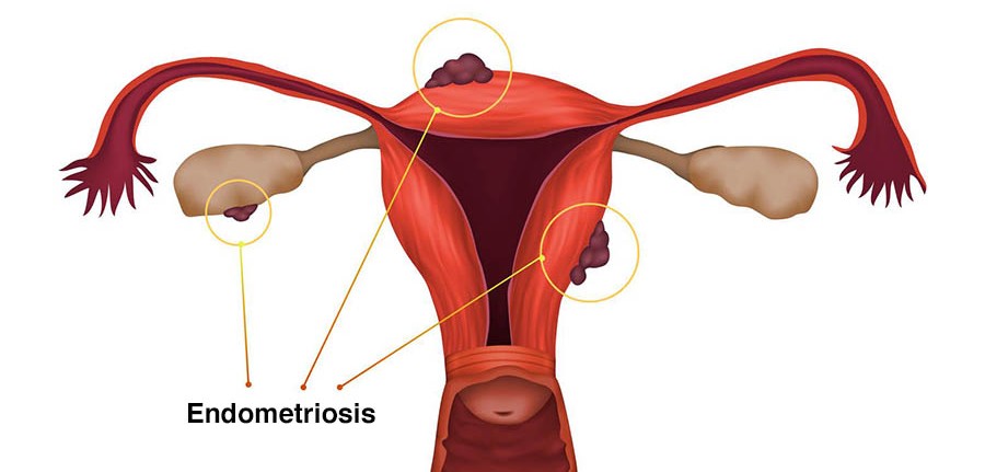 Endometriosis Treatment in Noida