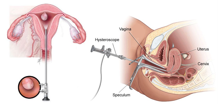 Hysteroscopic Procedures in Noida