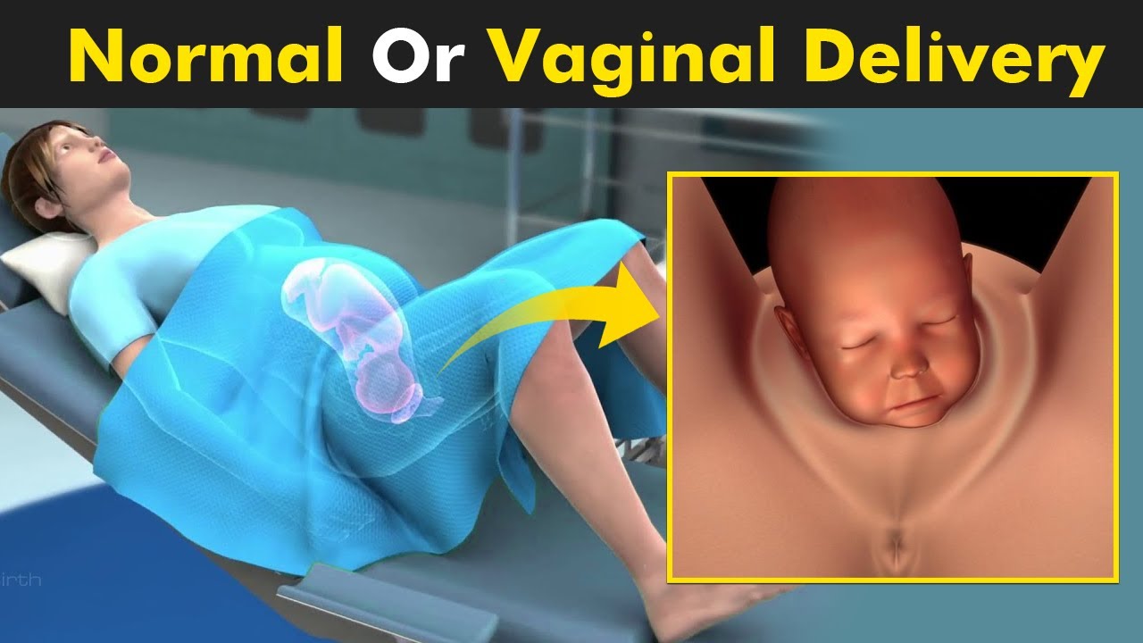 Normal Delivery Doctor in Noida