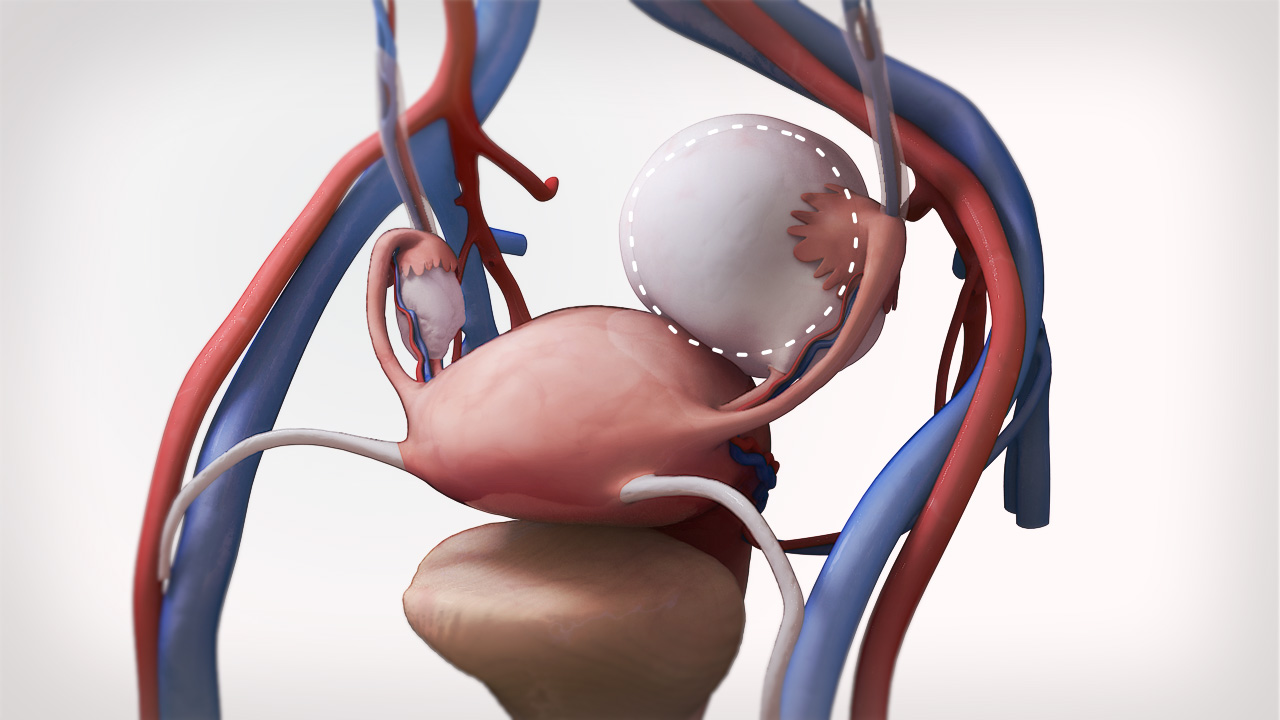 Ovarian Cyst Surgery in Noida