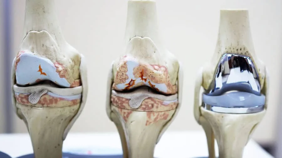 Total Knee Replacement Surgery in Greater Noida