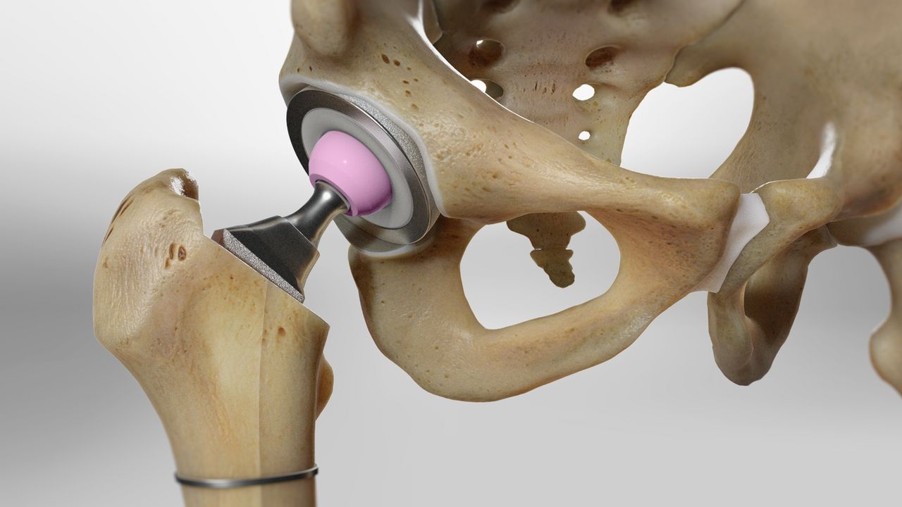 Total Hip Replacement Surgery in Greater Noida