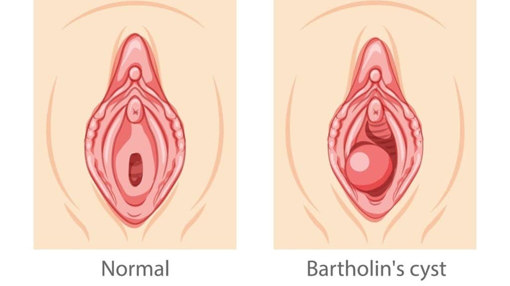 Vaginal Cyst Removal in Noida
