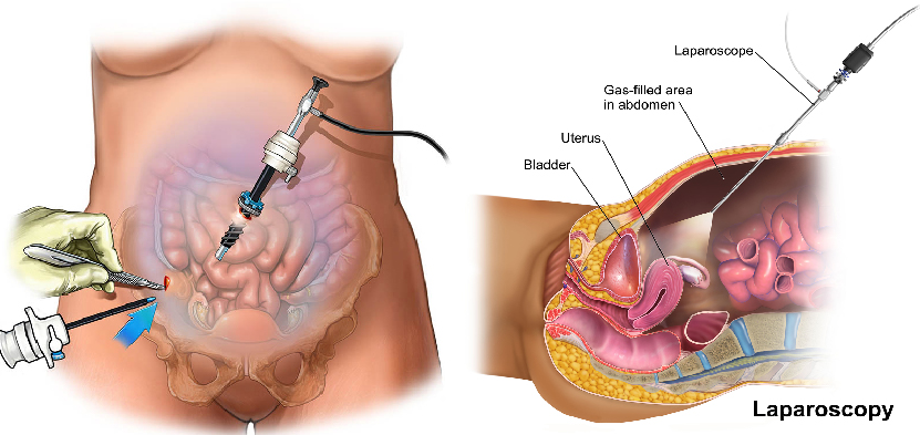 Advanced Laparoscopic Surgery in Noida