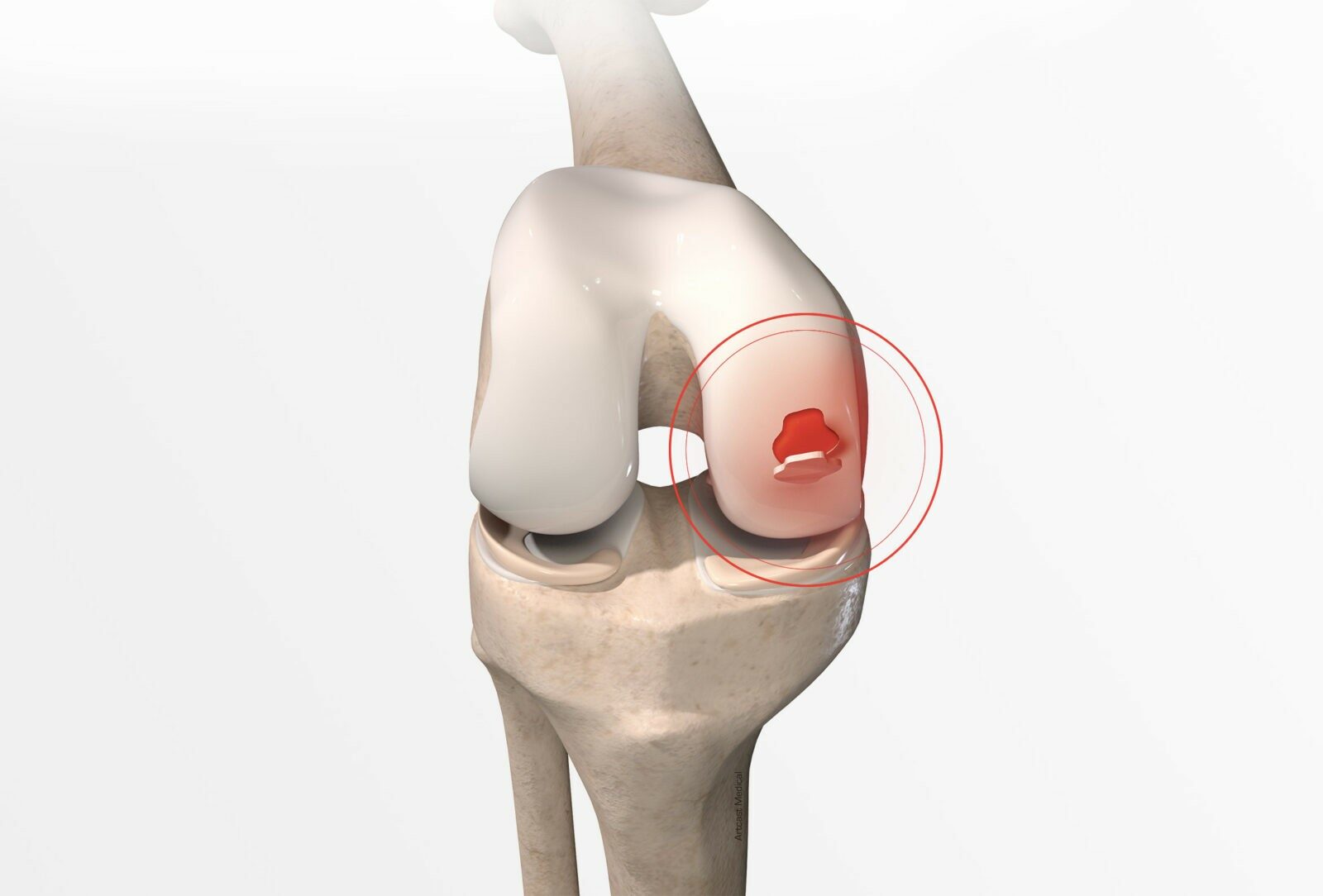 Fracture Specialist in Greater Noida