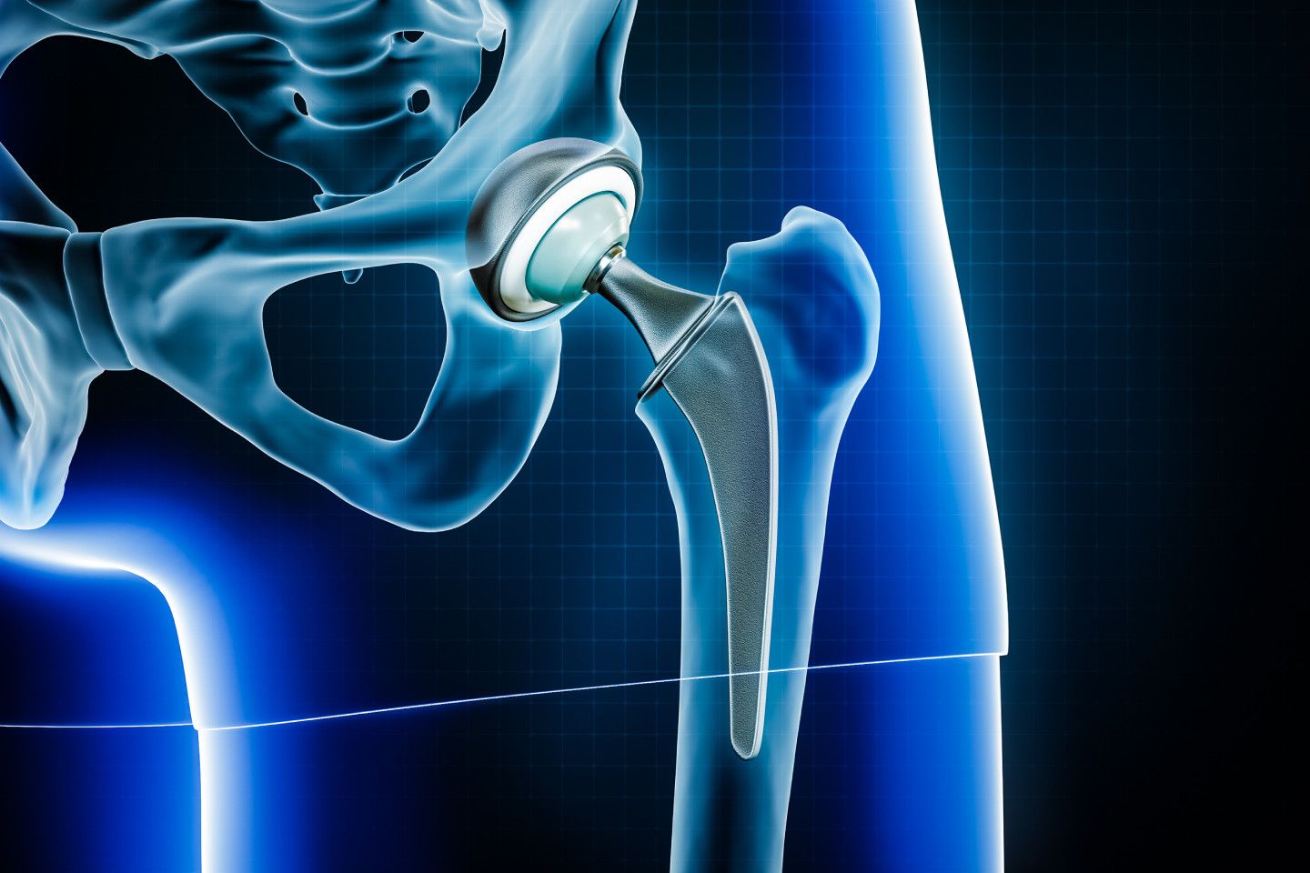 Conventional Hip Replacement in Greater Noida