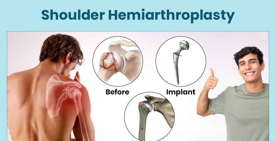 Hemi Shoulder Replacement in Greater Noida