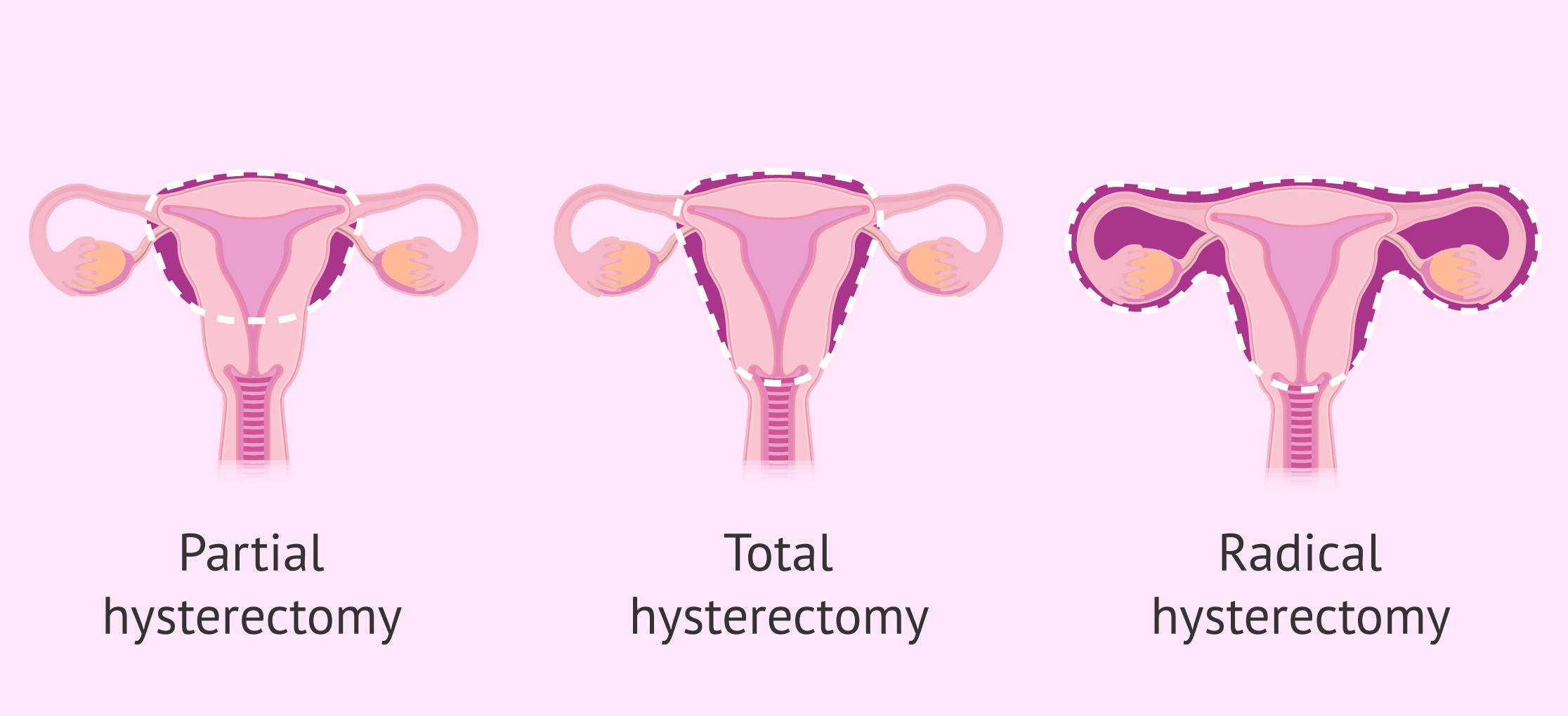Hysterectomy in Noida