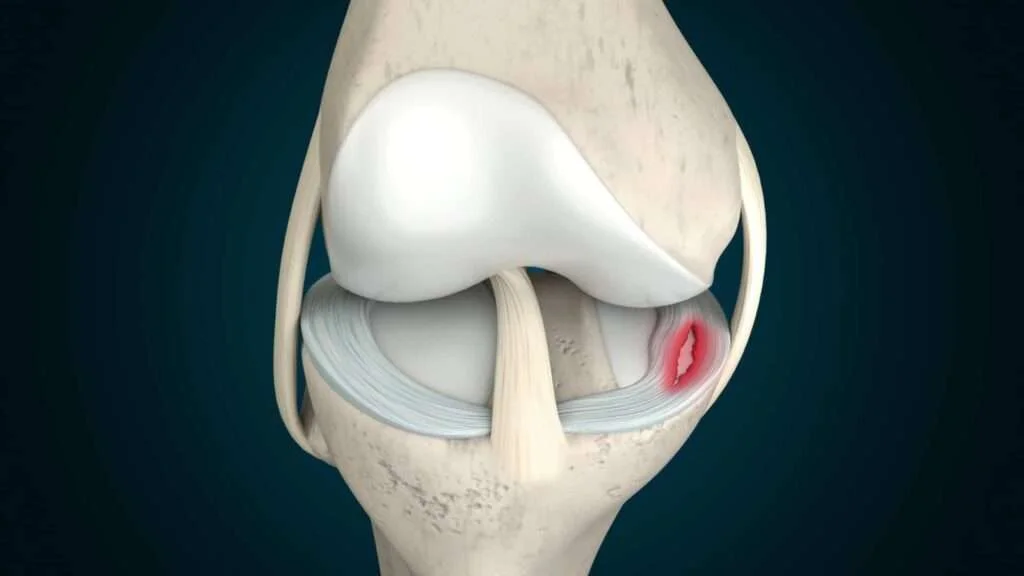 Meniscus Repair in Greater Noida