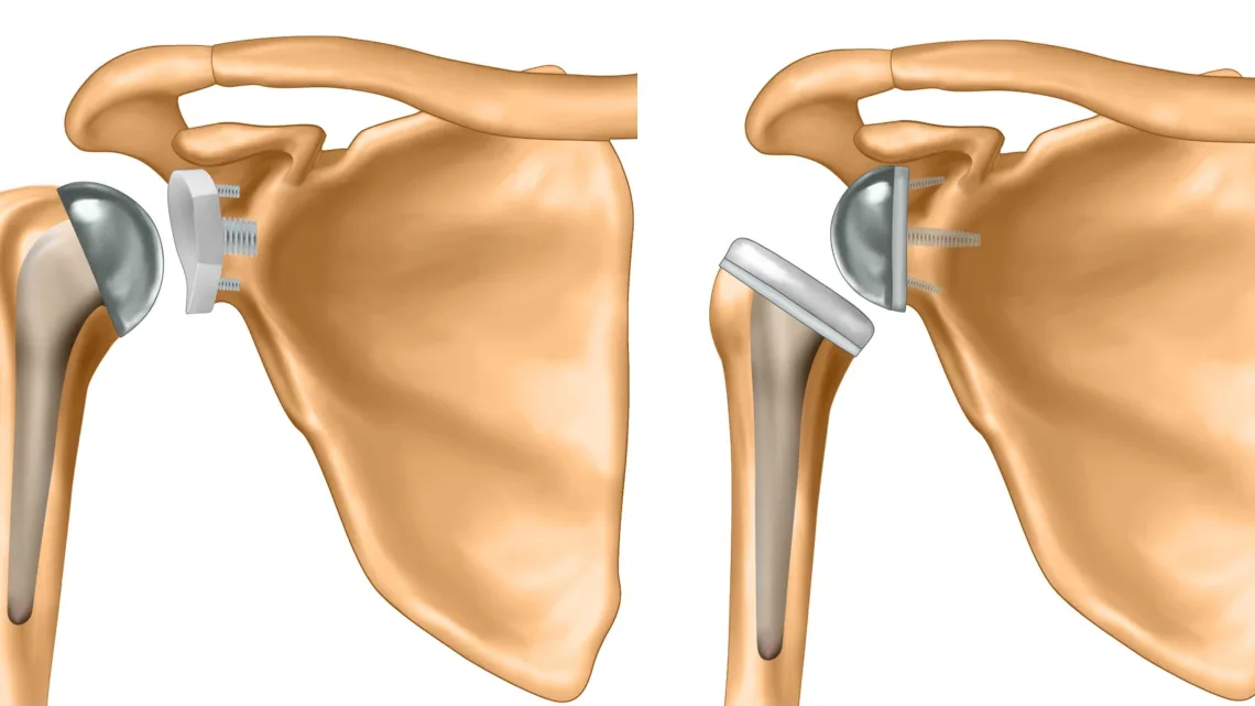Reverse Shoulder Replacement in Greater Noida