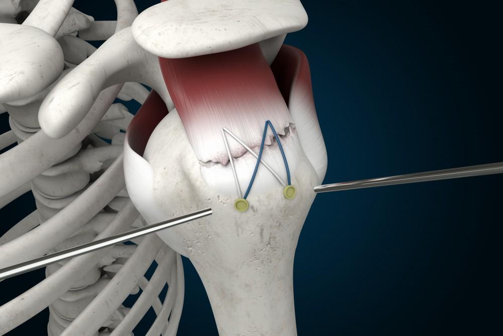 Rotator Cuff Repair in Greater Noida