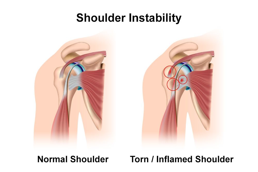 Shoulder Instability Surgery in Greater Noida
