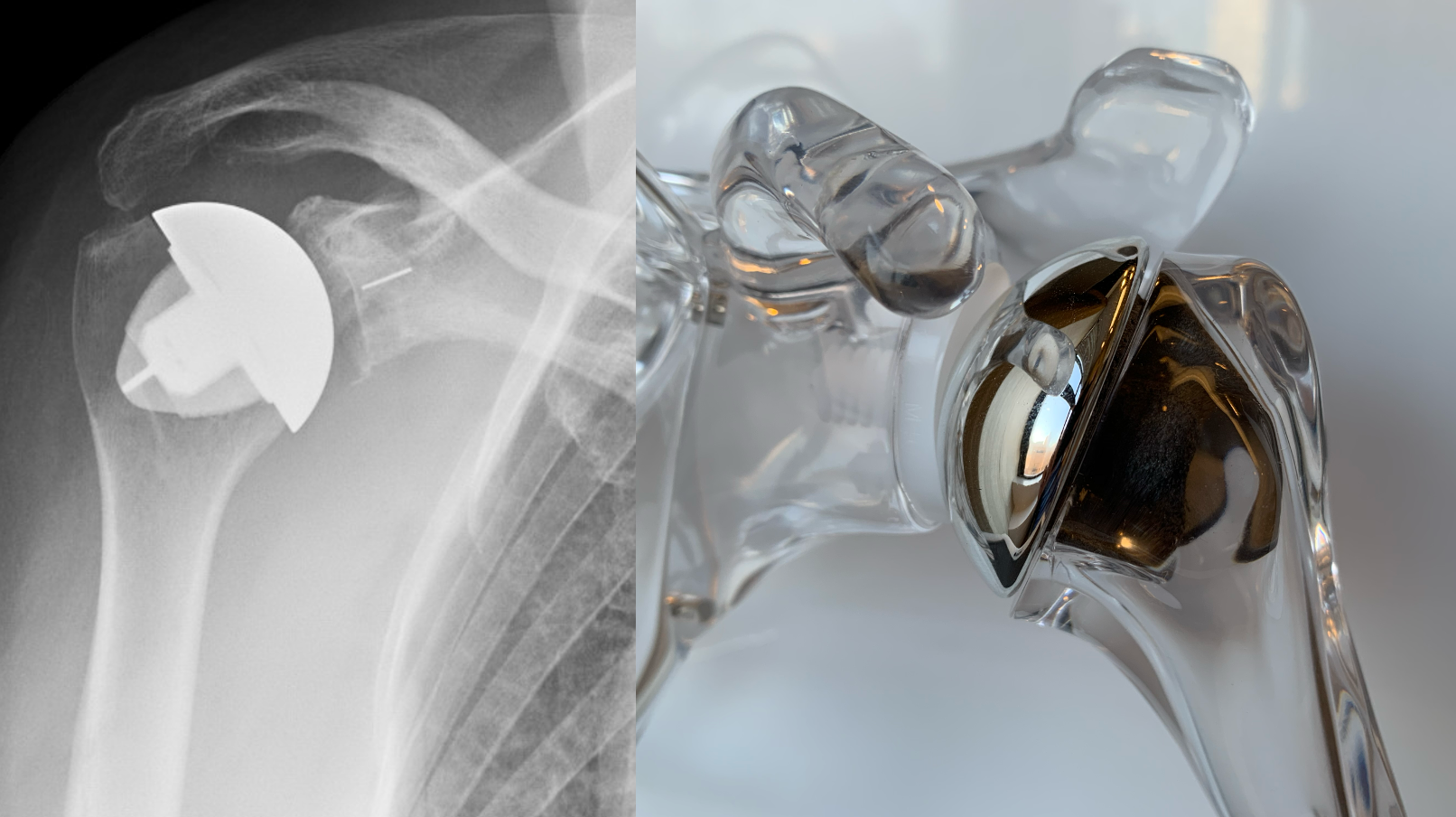 Total Shoulder Replacement in Greater Noida